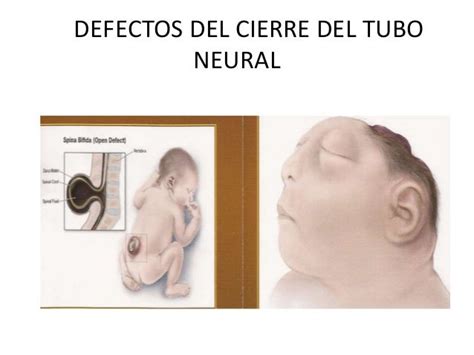 DEFECTOS DEL CIERRE DEL TUBO NEURAL