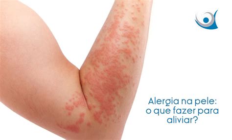 Como Aliviar Alergia Na Pele