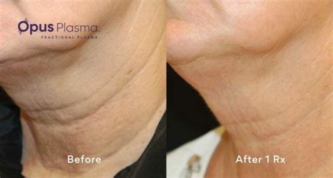 OPUS Plasma Skin Resurfacing | Edmonton | Nakatsui Derm