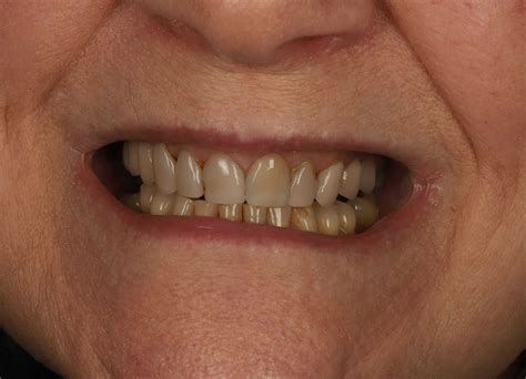 cheap veneers uk composite veneers    pm