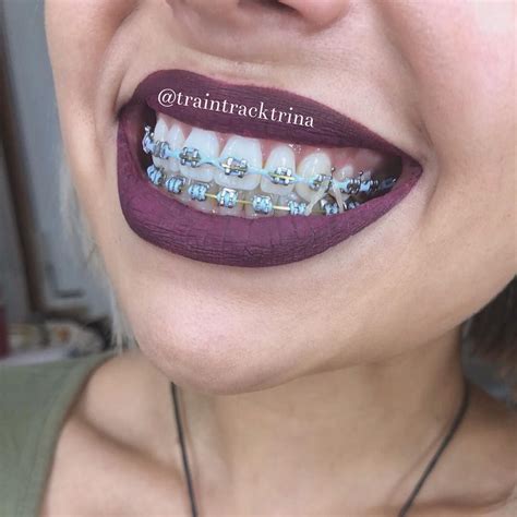 braces colors   teeth  whiter lets talk