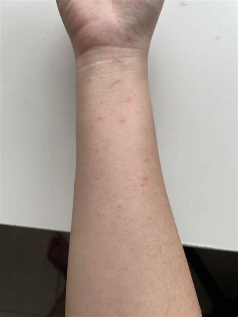I got a really bad allergic reaction from using Supergoop Unseen