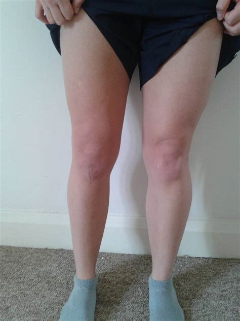 Leg Muscle Atrophy