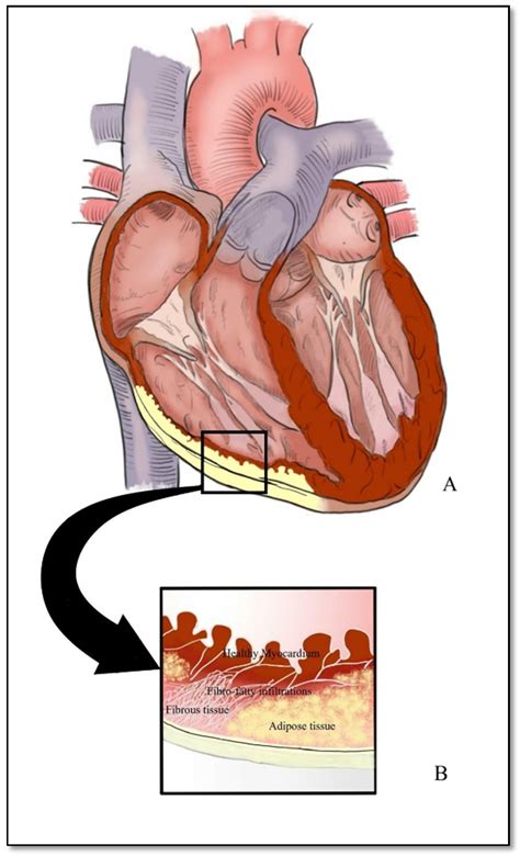 Arrhythmogenic Right Ventricular Dysplasia Histology