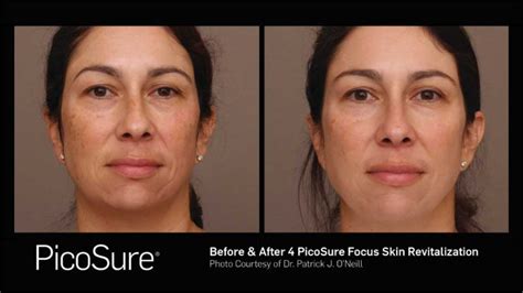 PicoSure Laser | Charleston, SC | O'Neill Plastic Surgery