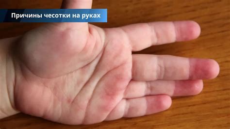 Чесотка на руках - 46 фото