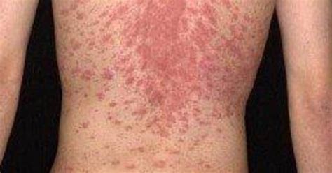 christmas tree rash  pityriasis rosea  mike lyles blog