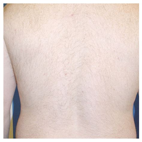 LASER HAIR REMOVAL – lsclaser