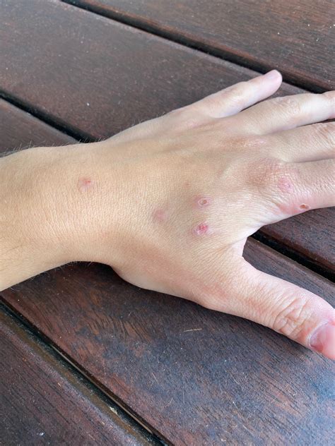 Is anybody have an idea what can be this ? Folliculitis ? I have the