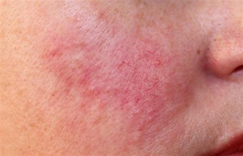 Help! My Skin Is Always Red — What Could It Be?: Manhattan Dermatology ...