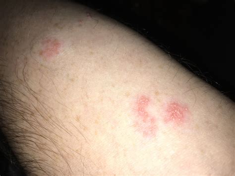 Armpit Rash