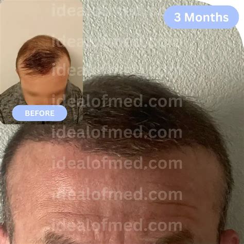 Hair Transplant Results After 3 Months | Hair Growth, Images & Effects