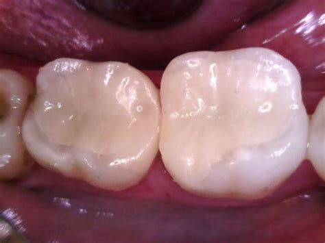 Leaking composite filling replacement - Dr Jeff Amos at The Mercury ...