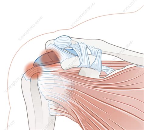 shoulder bursitis image  stella sexton blog