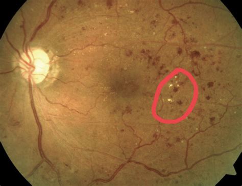 fundamentals  posterior segment flashcards quizlet