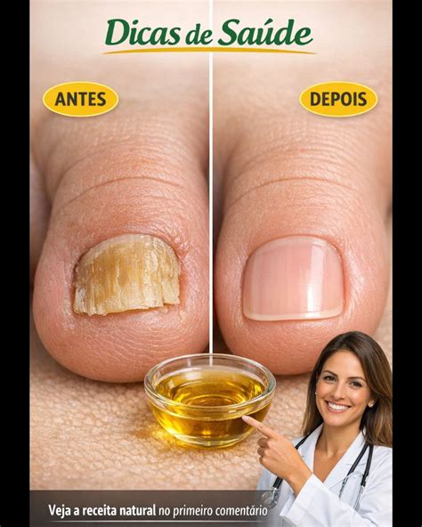 Fungo Na Unha Remedio Caseiro - 🦶 Remédio Caseiro para Fungos nas Unhas: A Fórmula Natural que ...
