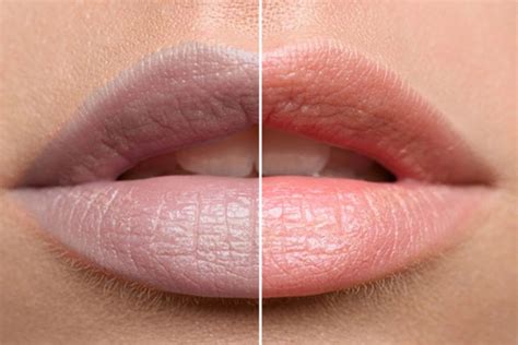 Khử thâm môi là gì? Những lưu ý để khử thâm môi hiệu quả