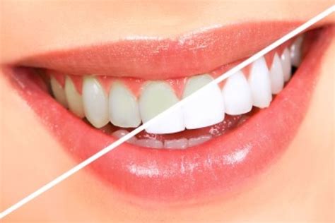 Are There Side Effects From Teeth Whitening? – Kelli Slate, DDS