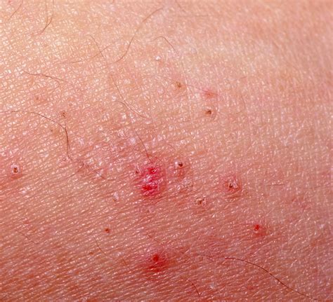 Do Scabies Live On Hard Surfaces at Henry Lackey blog
