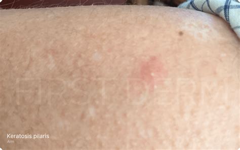 itchy bumps  arms