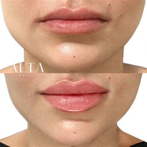 Natural Lip Fillers London | Subtle Enhancement | ALTA Medispa