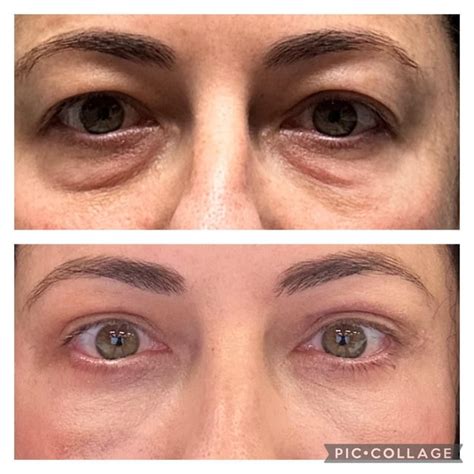 month post upper   bleph rplasticsurgery