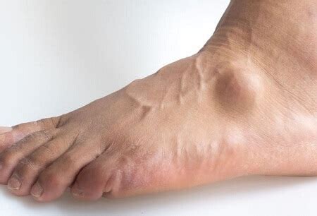 lump    foot  big toe hot sale emergencydentistrycom