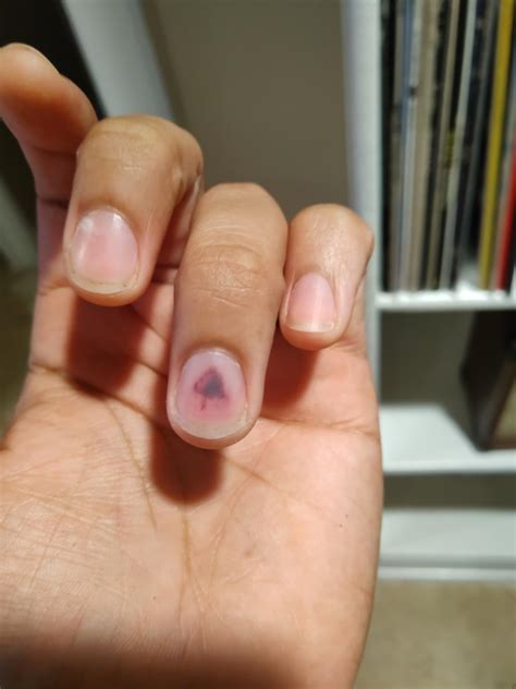 Smashed my finger at work today and got an updoot : r/mildlyinteresting