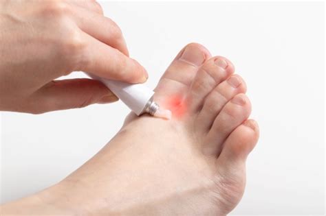 Mikoz - Manfaat, Dosis, dan Efek Samping - Alodokter