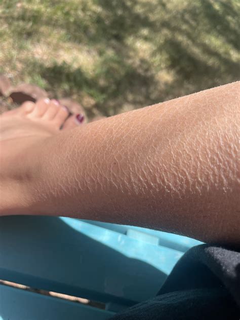 !Chronic Dehydrated Skin! : r/30PlusSkinCare