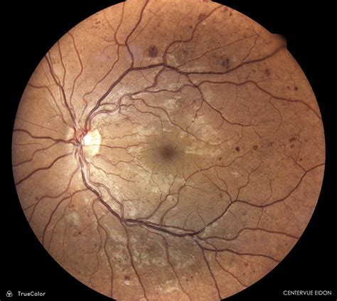Patient Cases - West Wichita Family Optometrists