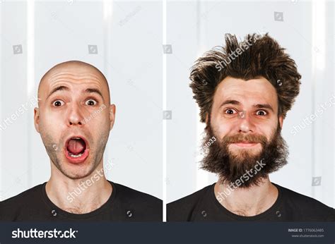 bald man   transplant hair stock photo  shutterstock