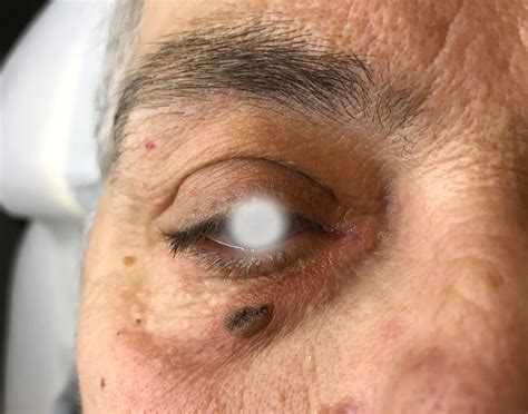 Medicina Estetica Verona | ASPORTAZIONE NEI E NEOFORMAZIONI BENIGNE