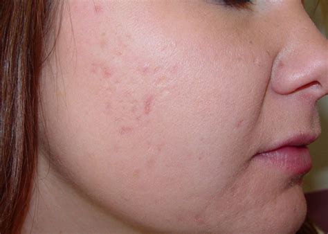 Infantile Acne