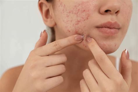 Dermatological Treatments for Acne Scars vs Home Treatments - Stratum ...