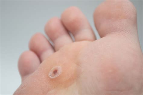 O Que É Verruga Plantar - Verruga plantar: o que é, sintomas, causas e tratamento - Tua Saúde