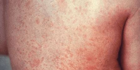 Symptoms Of Tigdas Hangin And Everything You Need To Know About It