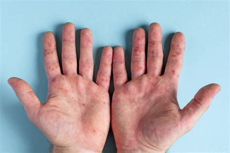 Hand Foot Mouth Disease Blisters On Feet Online | emergencydentistry.com