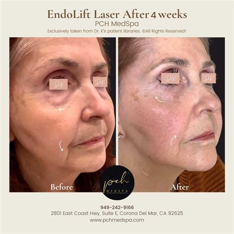 Best Endolift Laser Treatment Southern California,PCH MedSpa