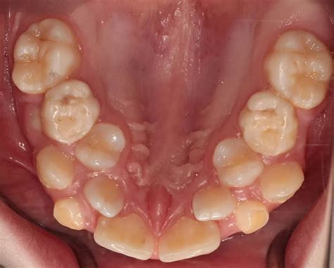 Hyperdontia Real