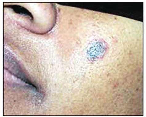 Cutaneous lesion of discoid lupus. | Download Scientific Diagram