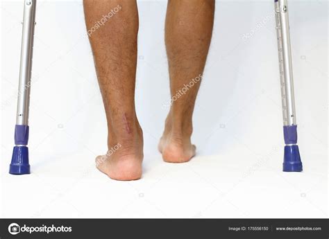 Calcaneal tendon rupture. Achilles Tendon Rupture: Causes, Symptoms ...