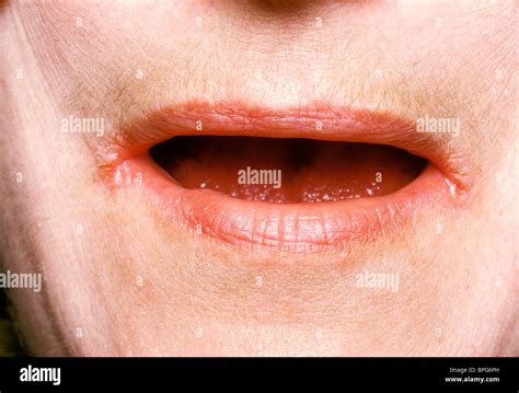 Angular Cheilitis In Children