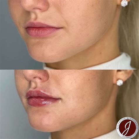 Lip Fillers Before and After 1ml Hyaluronic Acid