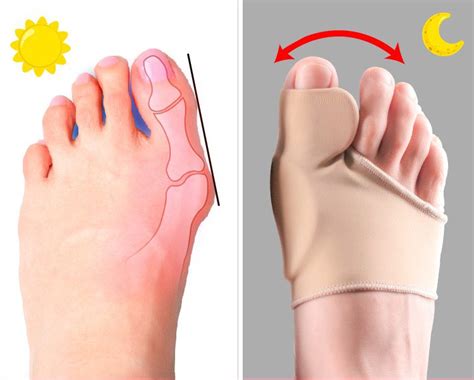 apakah bunion berbahaya qalofa