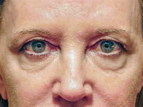 reset upper lids adam scheiner md dr adam scheiner