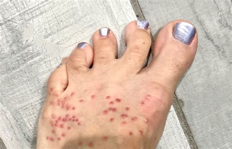 Chiggers - Defense Centers for Public Health - Aberdeen