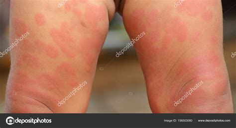 Eczema In Babies Legs