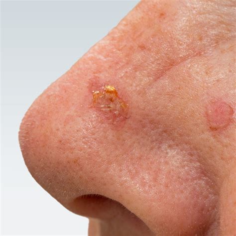 Actinic Keratosis | Skin Physicians Dermatology