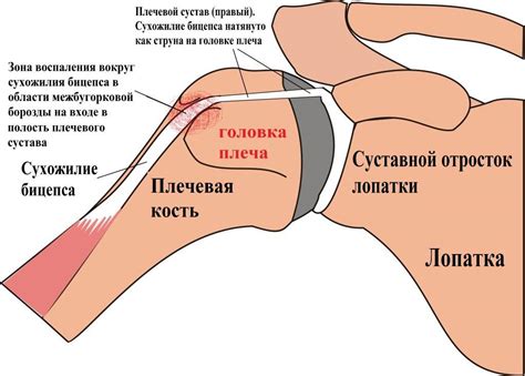 Плечевой сустав боль при поднятии руки: причины, характер, лечение ...